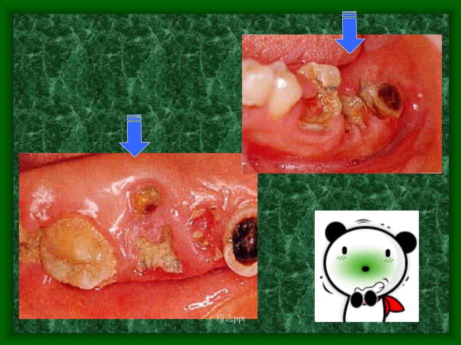 龋病详解及图库1_第5页