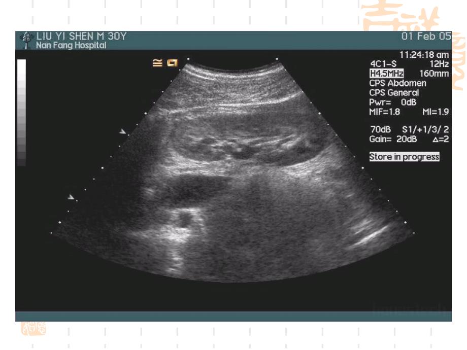 泌尿系统超声诊断_第3页