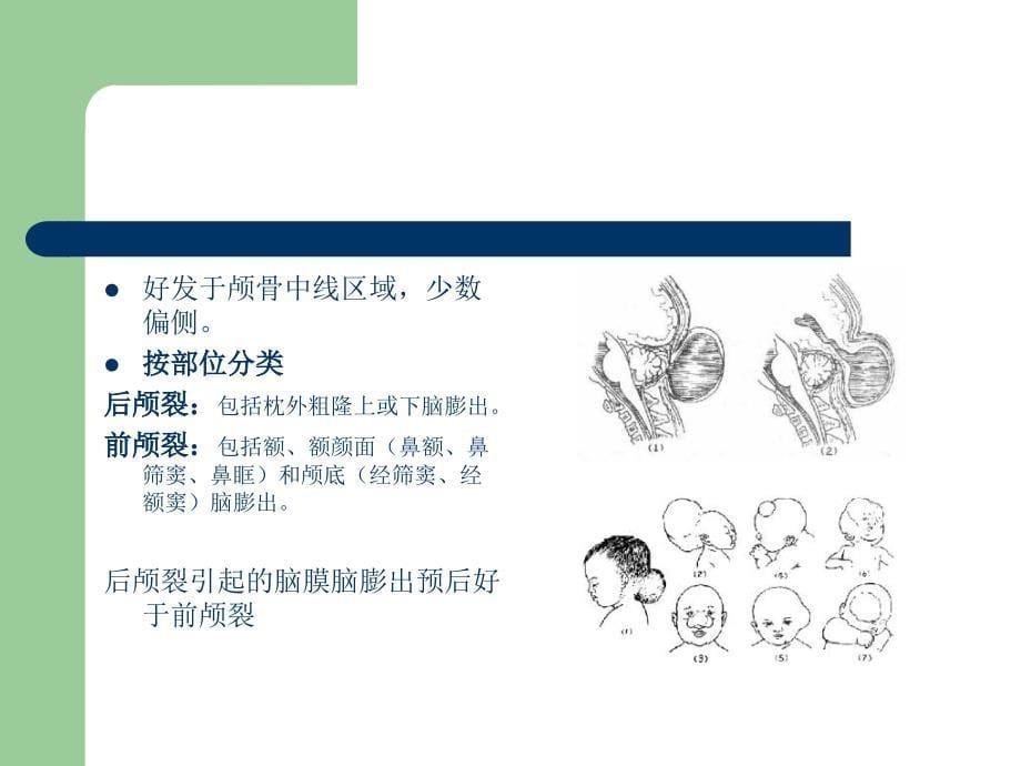 先天性疾病和脑积水孟庆海_第5页