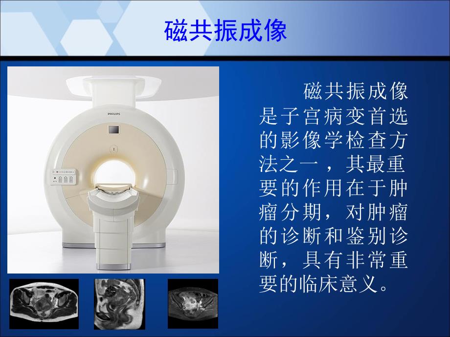 子宫内膜癌MRI影像表现_第2页