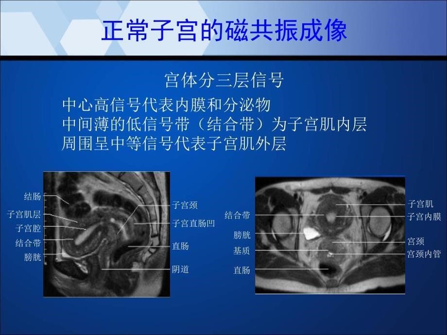 子宫内膜癌MRI影像表现_第5页