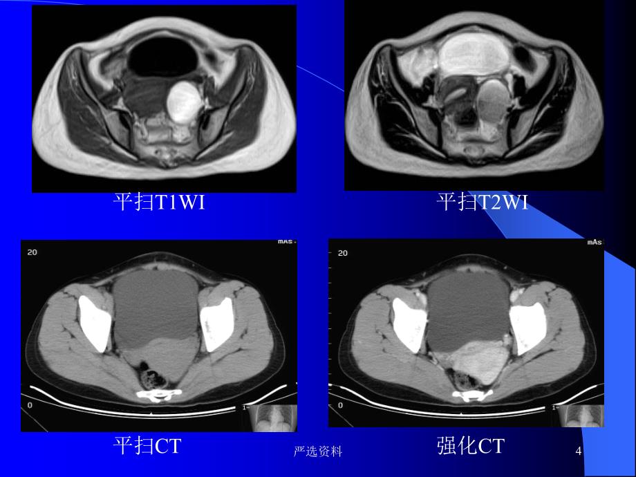 盆腔疾病的MR诊断（行业荟萃）_第4页
