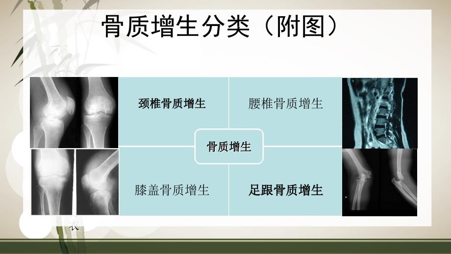 治疗骨质增生的偏方_第2页