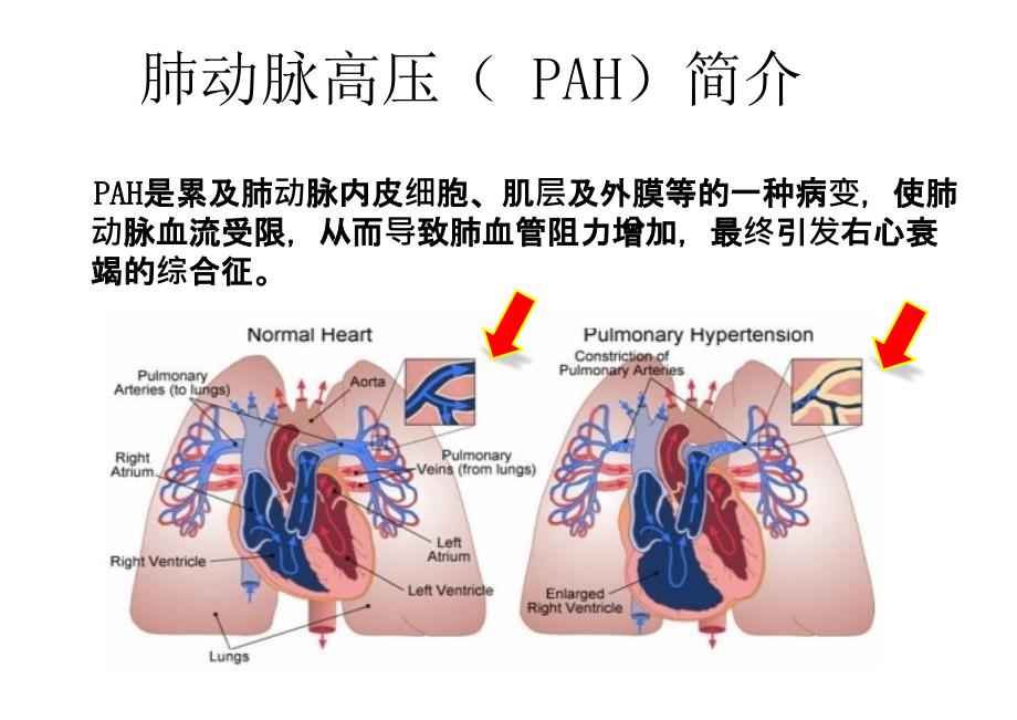 肺动脉高压查房_第2页