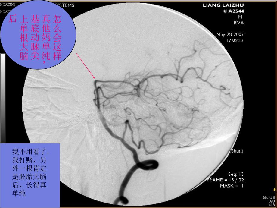 胚胎形大脑后动脉血管造影专题讲座_第3页