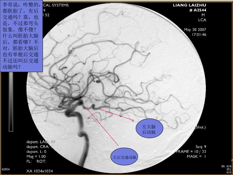 胚胎形大脑后动脉血管造影专题讲座_第4页