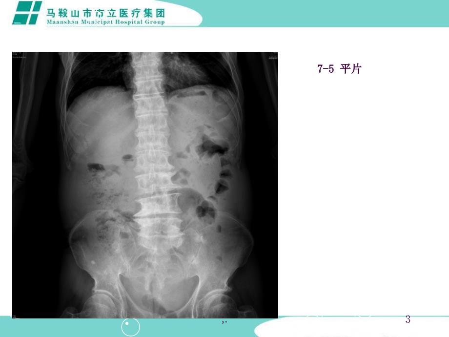 假性粘液瘤ppt课件_第3页