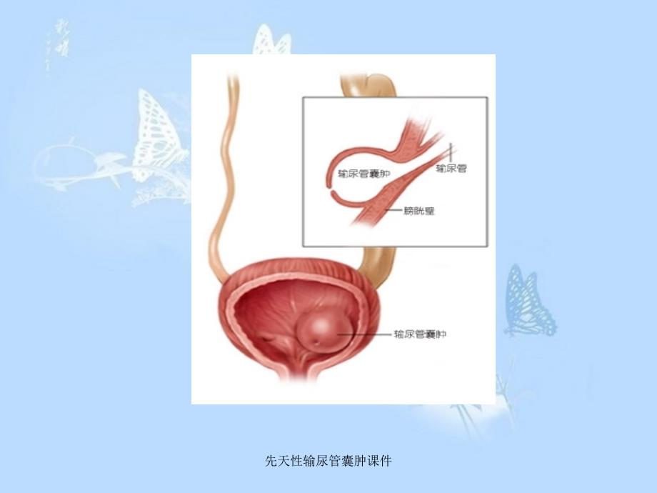 先天性输尿管囊肿课件_第4页