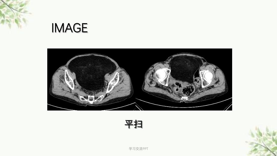 脂肪肉瘤一例CT表现ppt课件_第3页