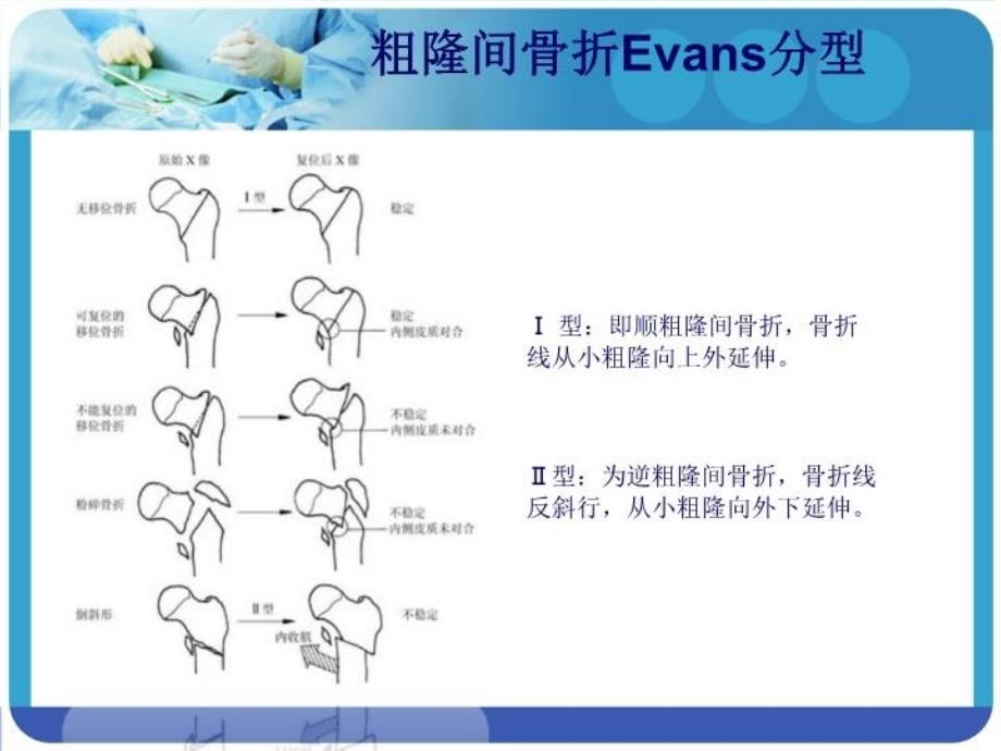 PFNA在股骨粗隆间骨折的应用电子版本_第4页