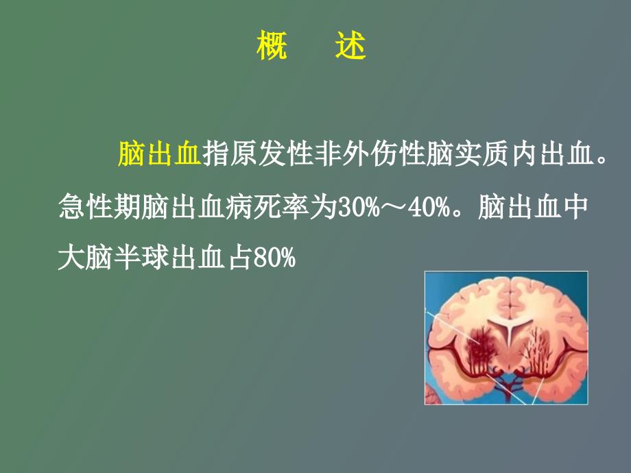 急性脑血管疾病出血性_第4页