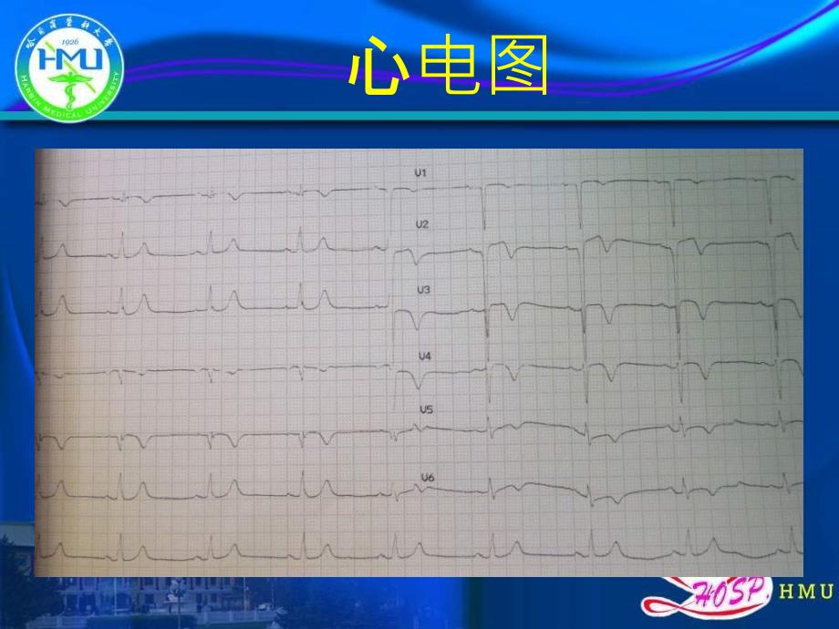 晚期药物支架内血栓2例病因分析_第4页