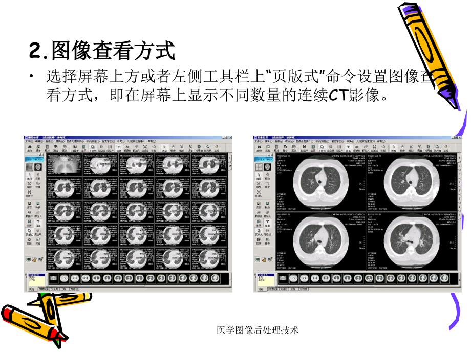 最新医学图像后处理技术PPT_第4页