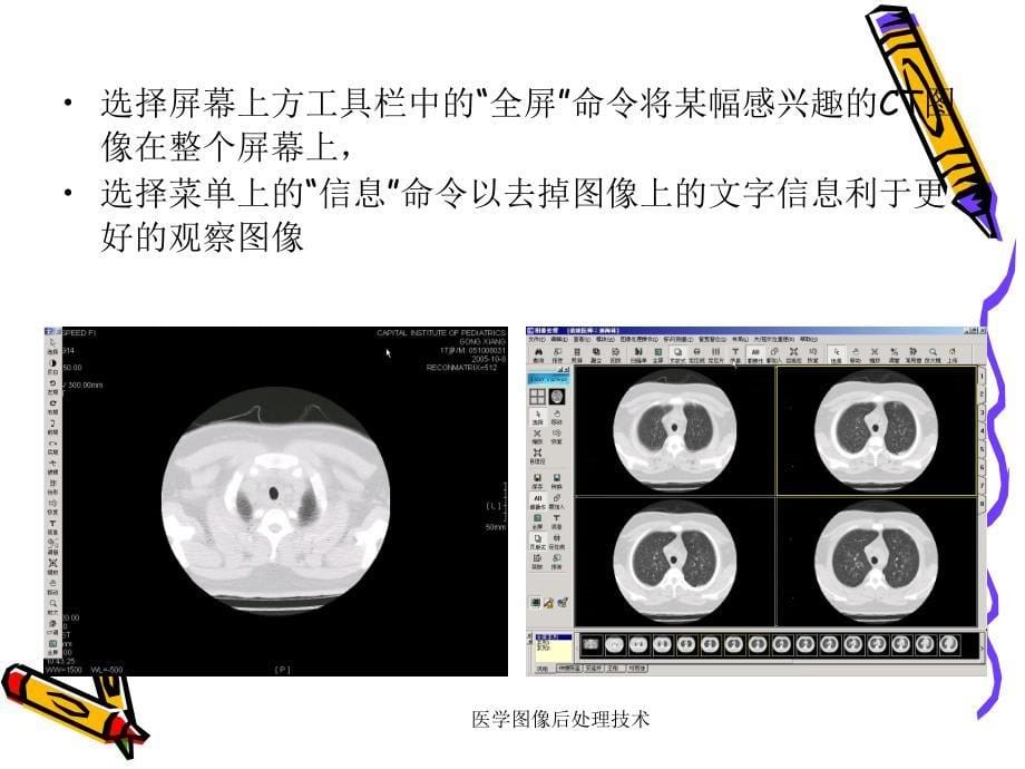 最新医学图像后处理技术PPT_第5页