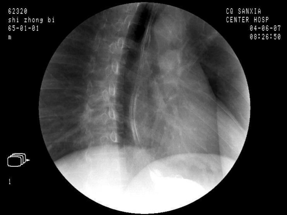 影像全套消化道钡餐_第3页