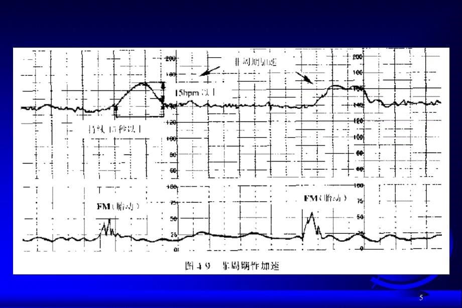 胎心监护课件_第5页