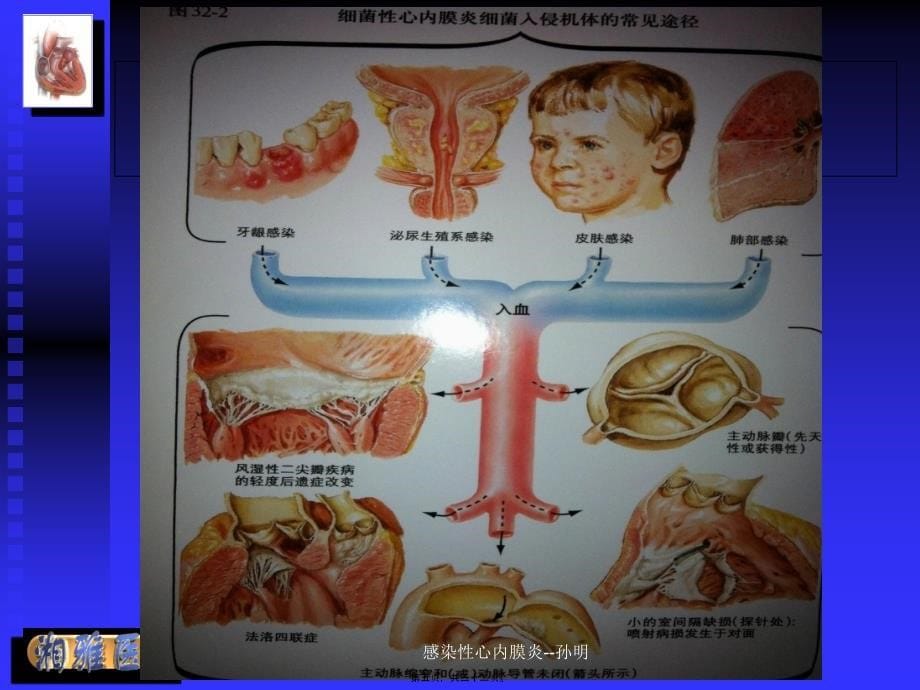 感染性心内膜炎孙明课件_第5页