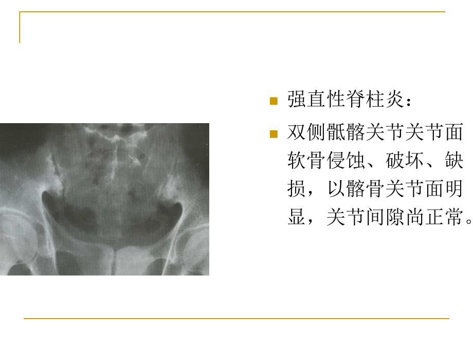 强直性脊柱炎整理_第3页