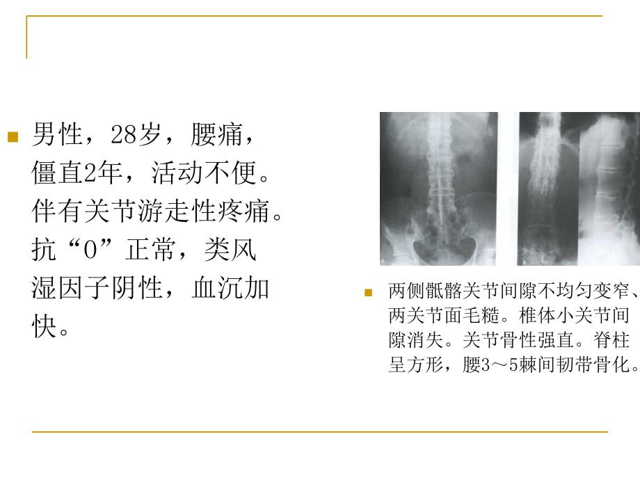 强直性脊柱炎整理_第4页