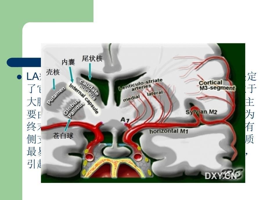 脑白质疏松症leukoaraiosisLA课件_第5页