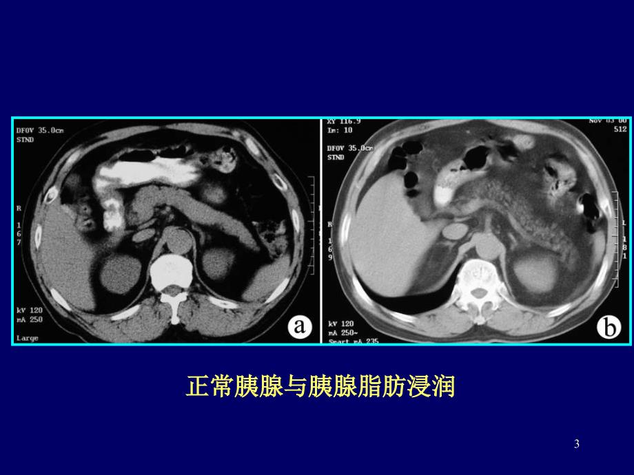 胰腺常见病变的CT诊断PPT课件_第3页