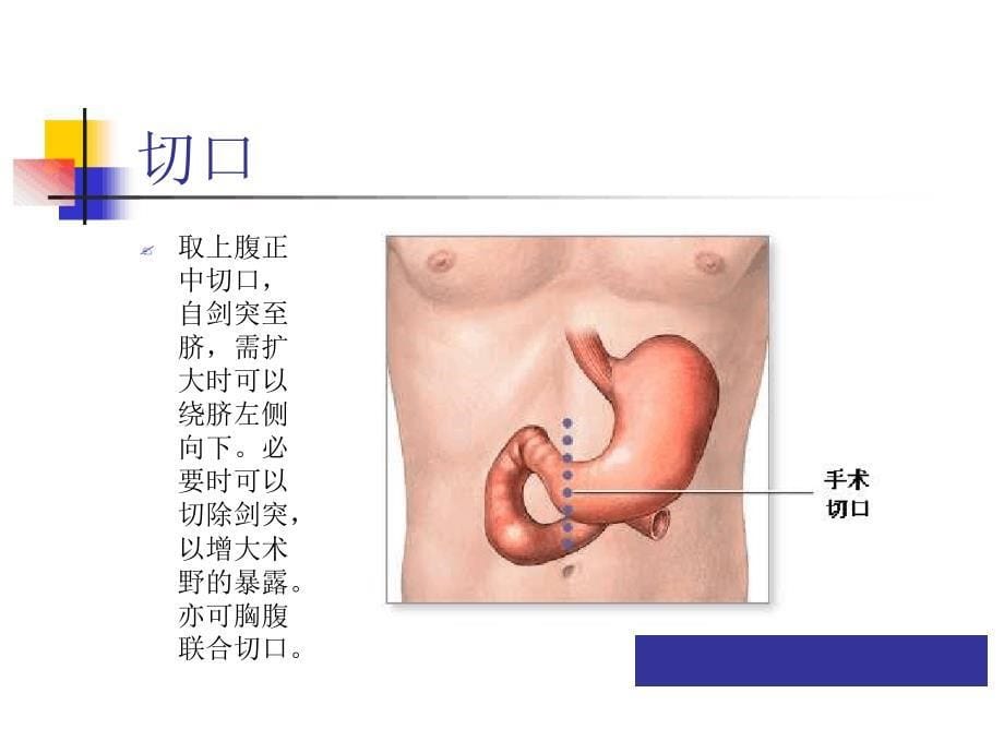 图解全胃切除术(一).ppt课件_第5页