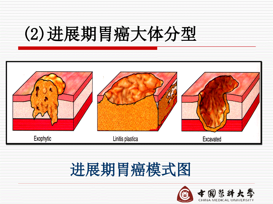 病理学课件10 消化系统疾病（3）_第4页