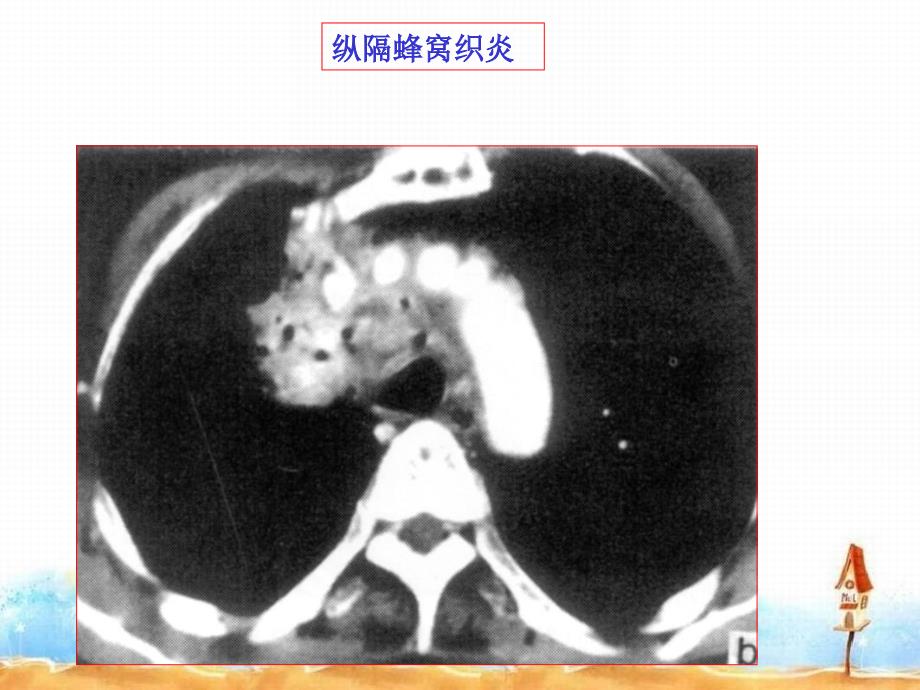 医学影像学第三节纵膈常见疾病的CT表现_第3页