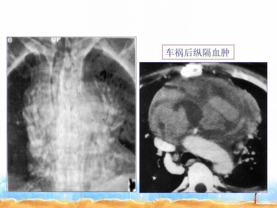 医学影像学第三节纵膈常见疾病的CT表现_第5页