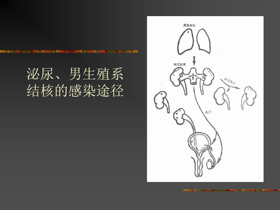 泌尿、男生殖系结核.ppt_第4页