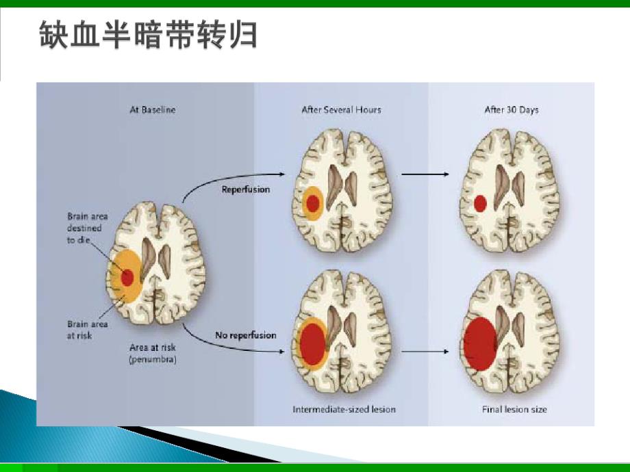 急性脑卒中绿色通道路径215_第3页