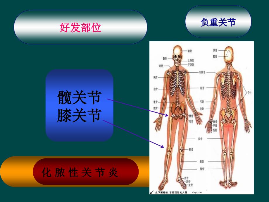 化脓性关节炎讲课用_第4页