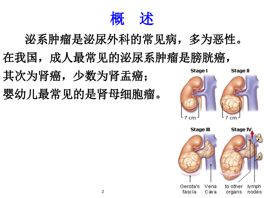 外科护理6泌尿系肿瘤护理课件_第2页