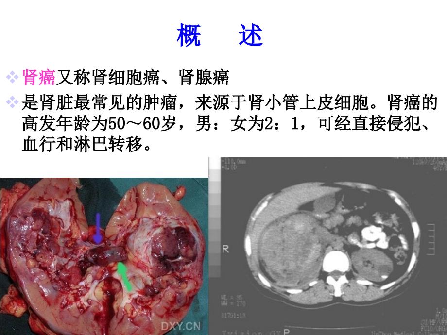 外科护理6泌尿系肿瘤护理课件_第4页