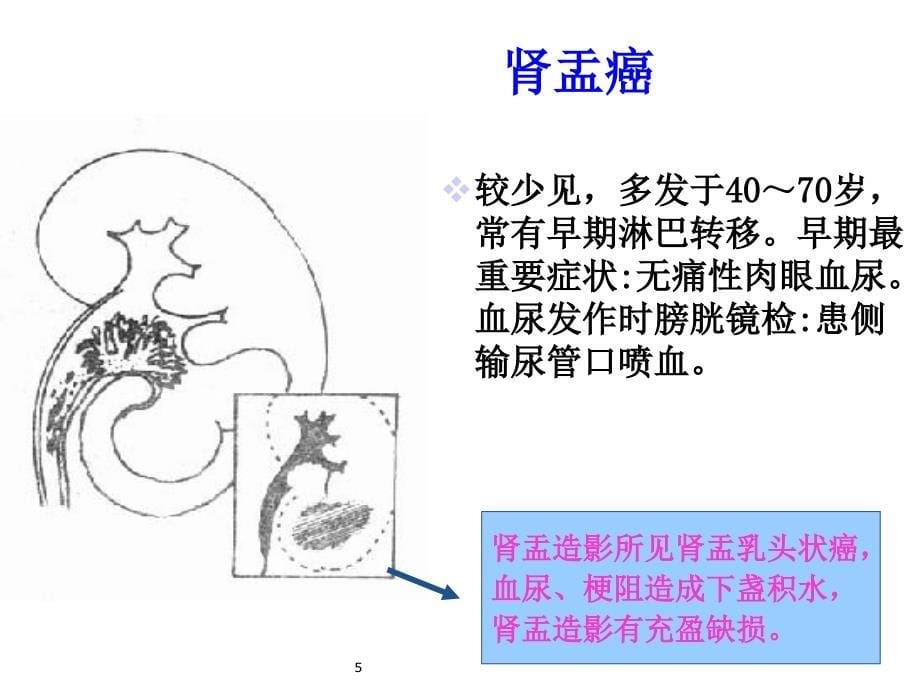 外科护理6泌尿系肿瘤护理课件_第5页