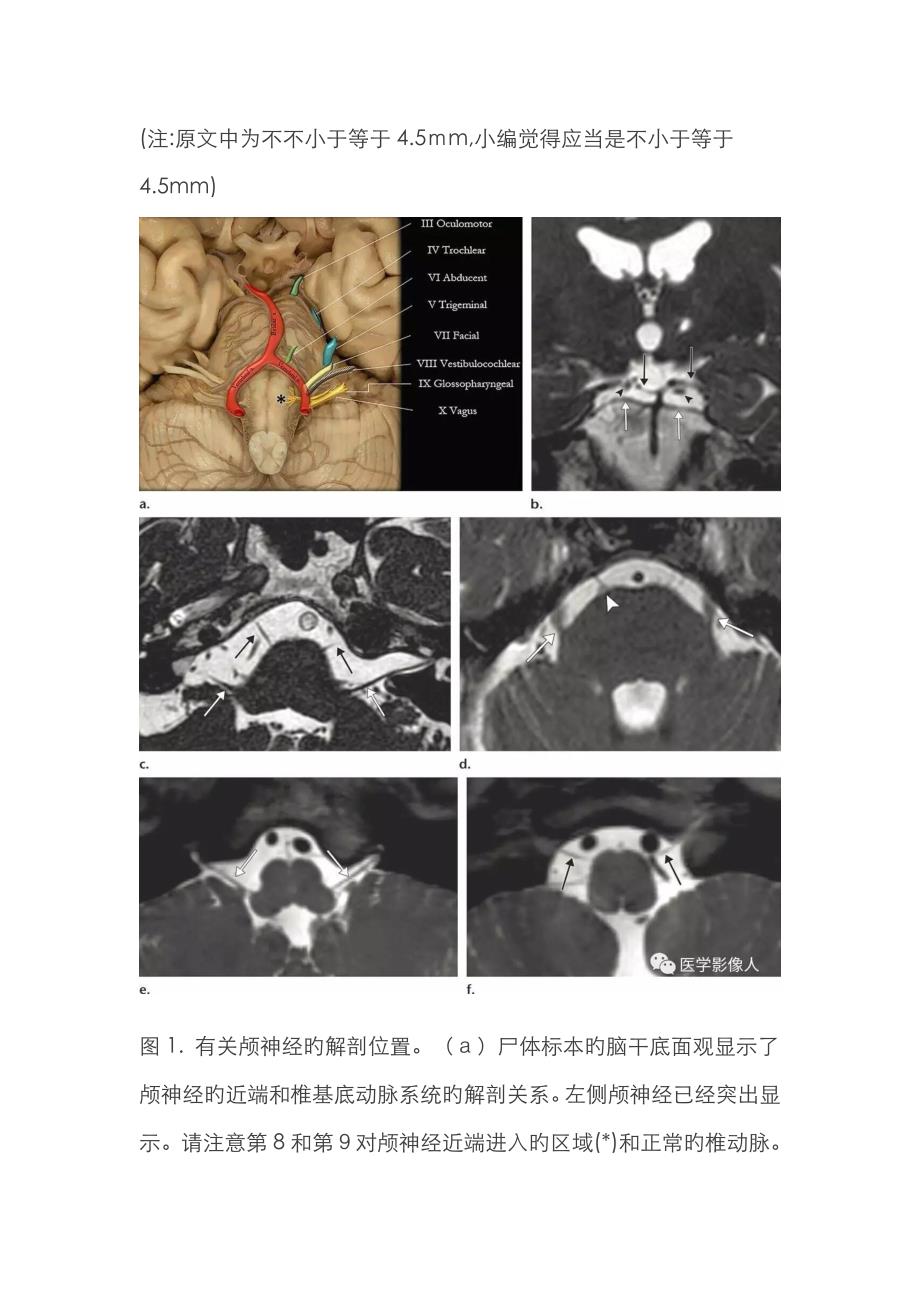 基底动脉延长扩张症_第4页