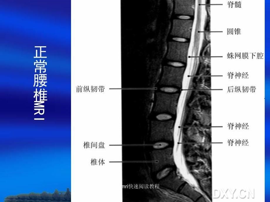 腰椎mri快速阅读教程课件_第5页