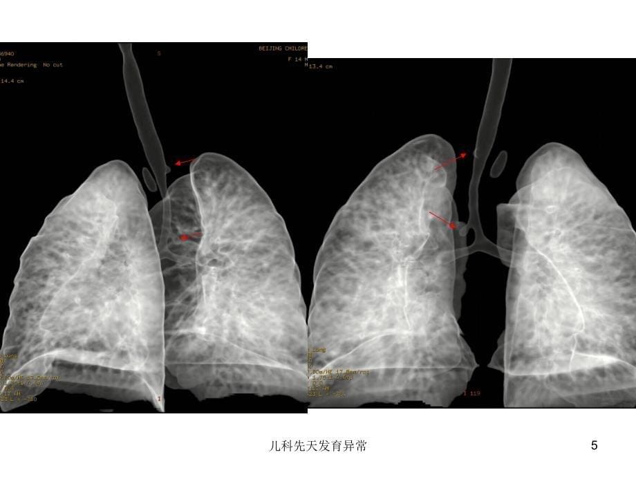 儿科先天发育异常课件_第5页