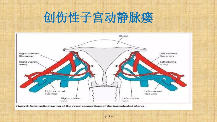 子宫动静脉瘘课件_第1页