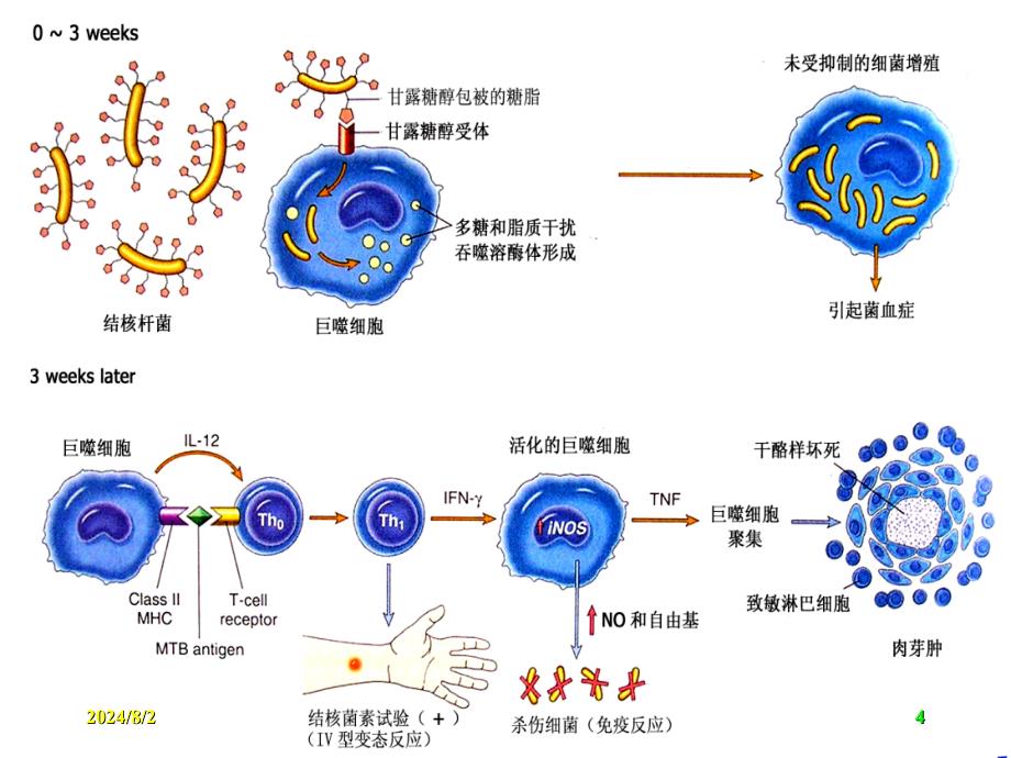 肺结核的CT诊断1_第4页