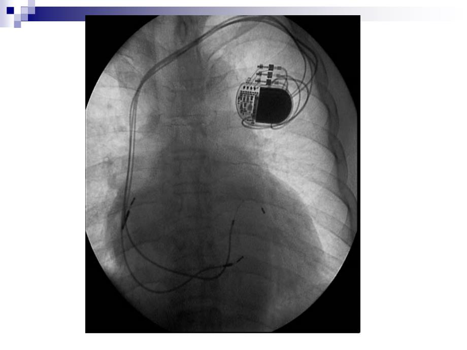 心脏起搏器ppt课件_第2页