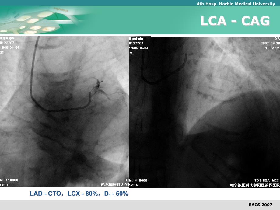 CTO Case：Retrograde approach_第4页