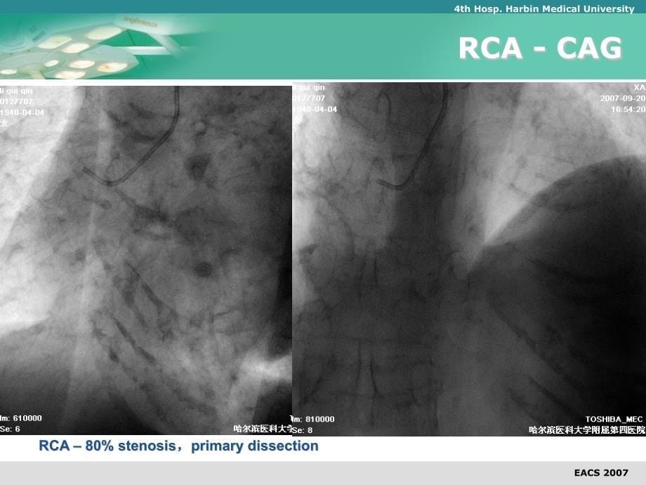 CTO Case：Retrograde approach_第5页