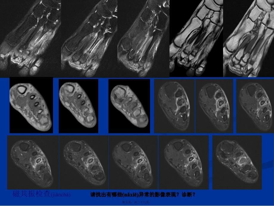 医学专题—影像学病例读片-应力性骨折_第5页