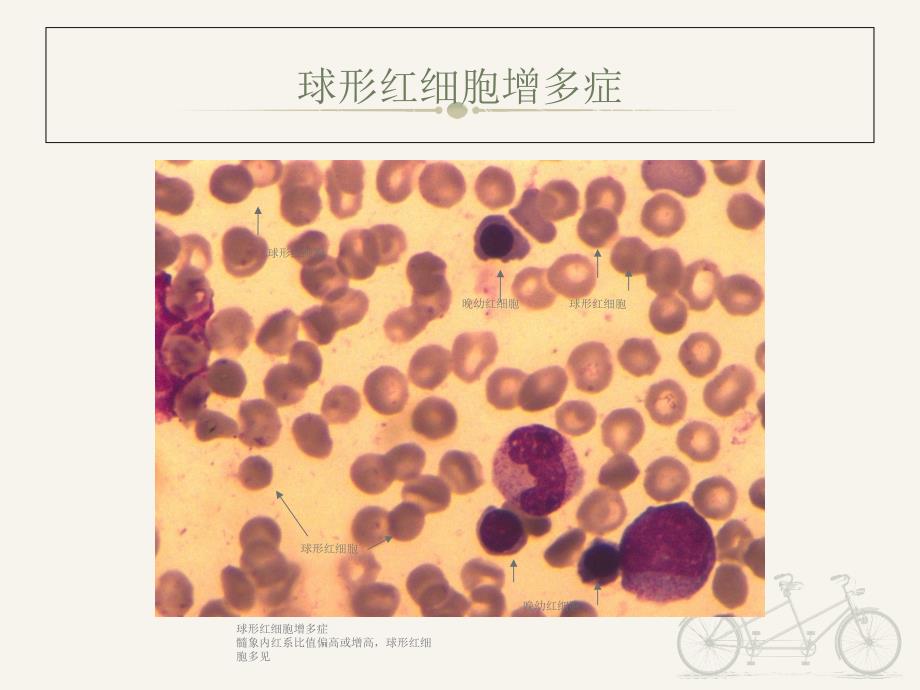 《诊断学》血液学检验图谱--课件_第4页