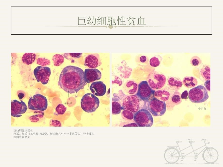 《诊断学》血液学检验图谱--课件_第5页