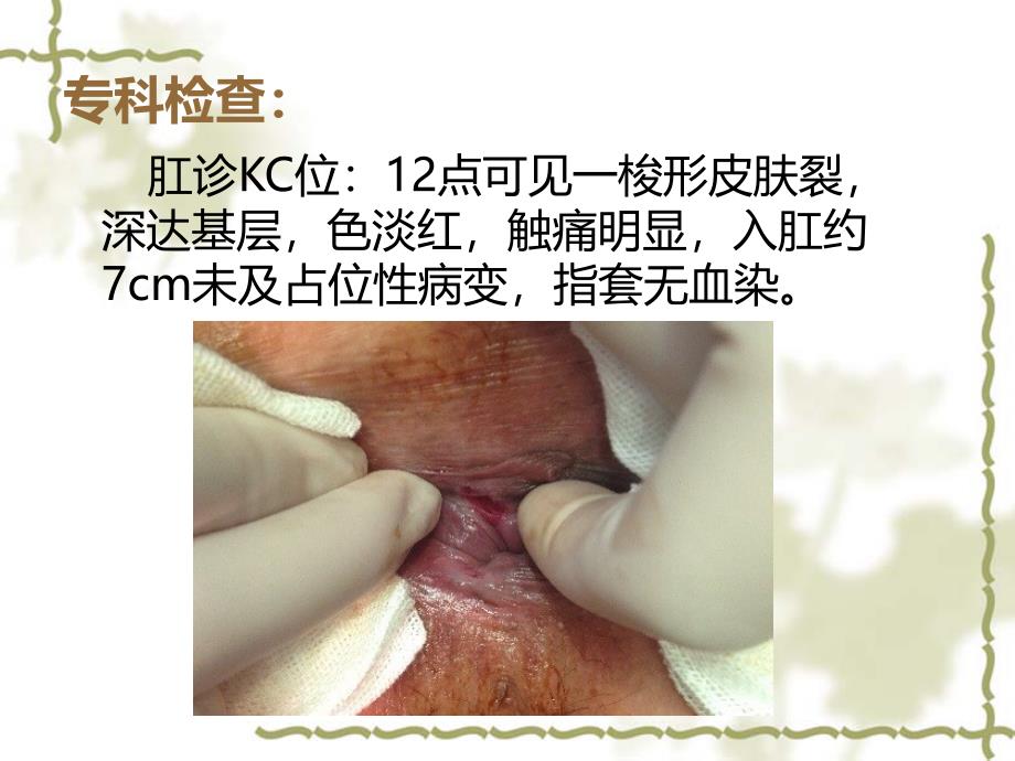 肛裂护理查房_第4页