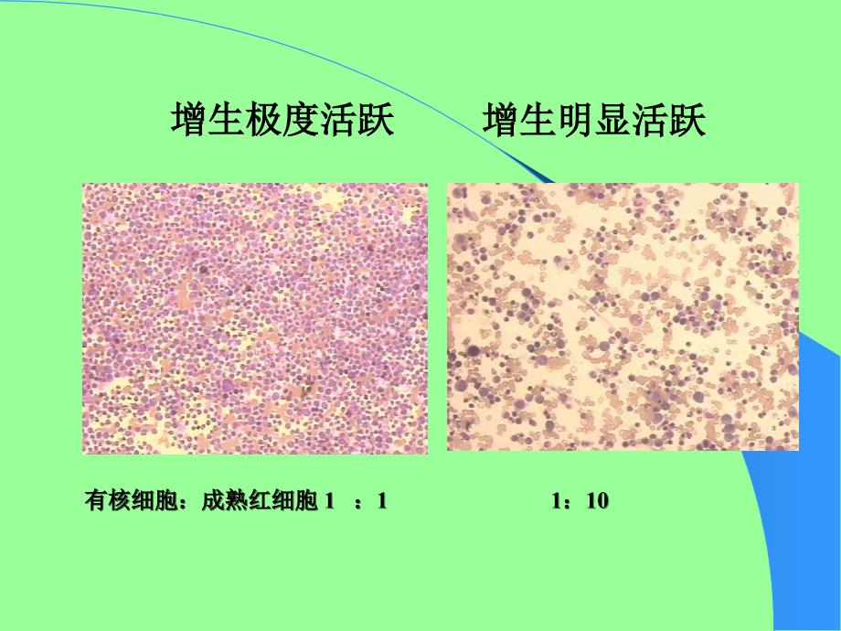 2014急性白血病实验室和其它检查结果情况.ppt_第3页