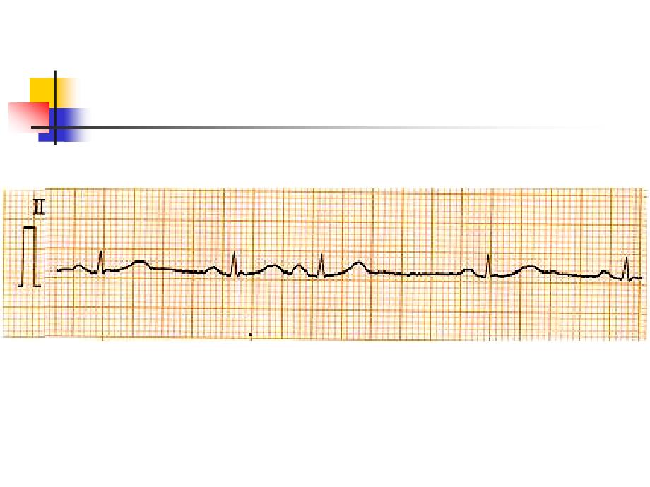 第三篇第三章心律失常 ppt课件_第2页