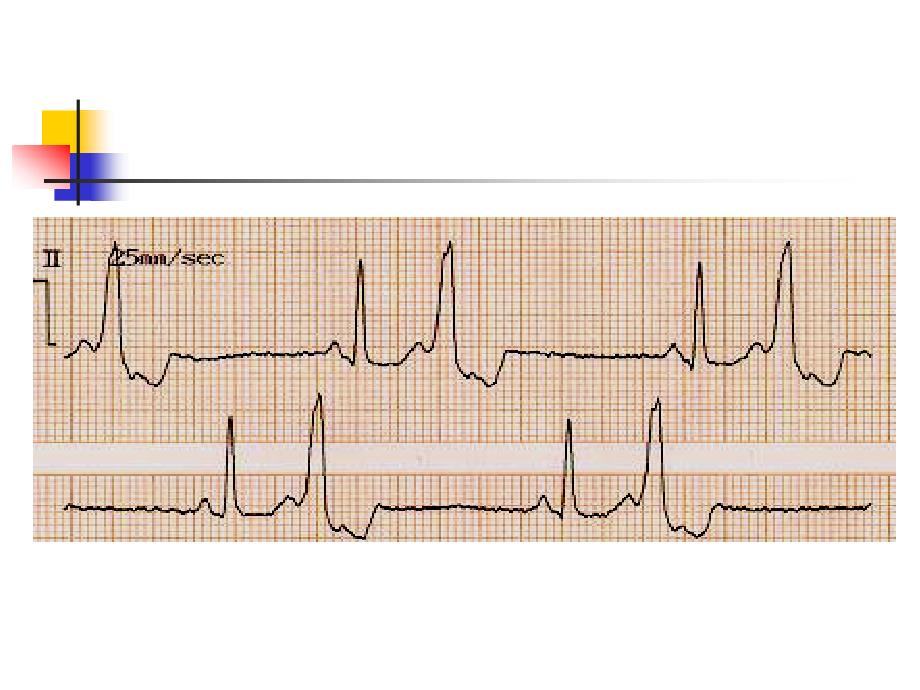 第三篇第三章心律失常 ppt课件_第3页